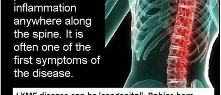 Spine pain lyme disease